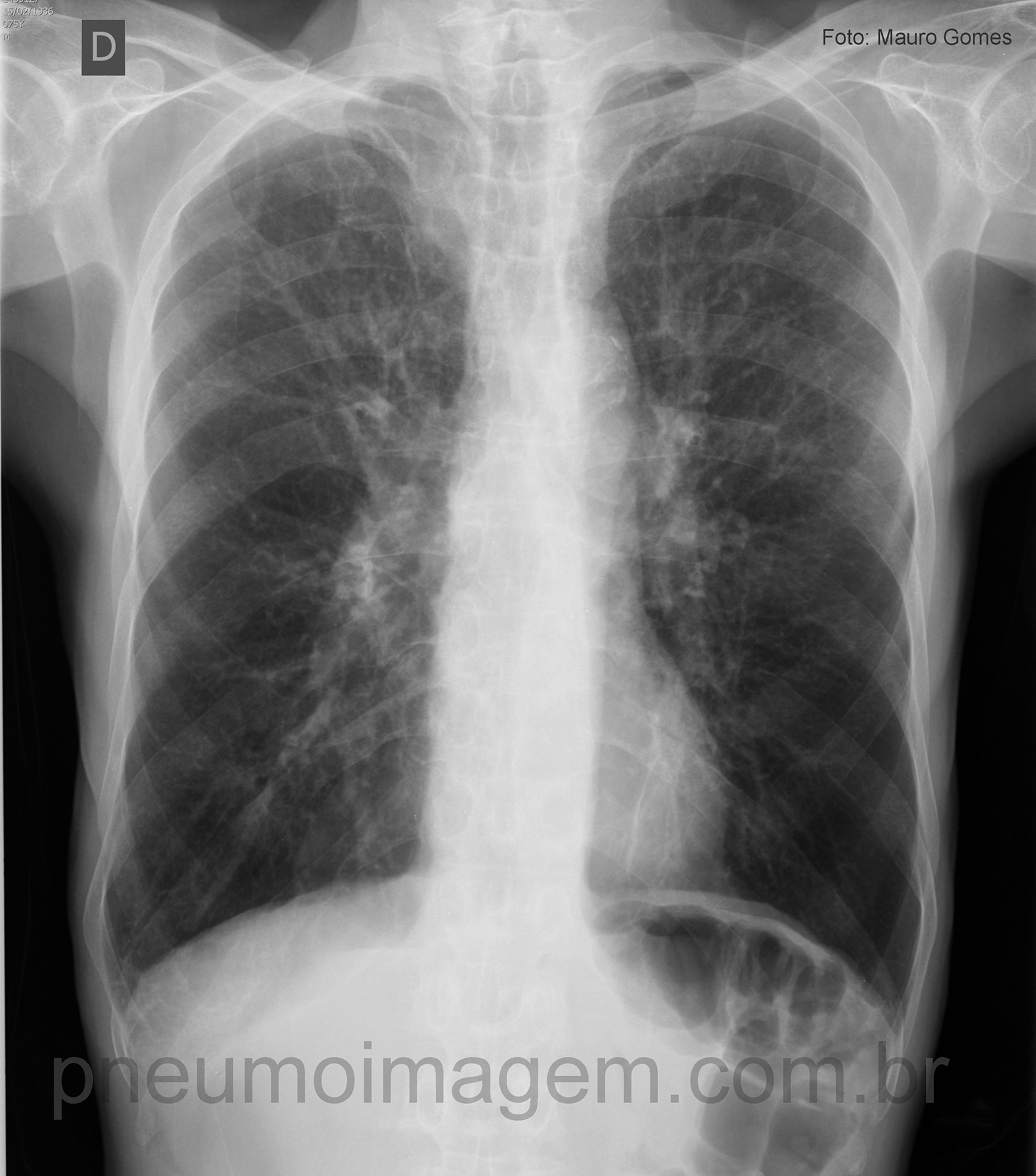 DESTAQUES DO ERS2016: SUPLEMENTAÇÃO DE OXIGÊNIO EM DPOC E OS EFEITOS SOBRE O SNC DESTAQUES DO ERS2016: SUPLEMENTAÇÃO DE OXIGÊNIO EM DPOC E OS EFEITOS SOBRE O SNC